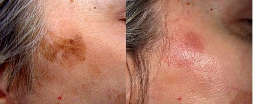 Actinic keratosis before and after