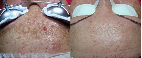 Melasma before and after treatment