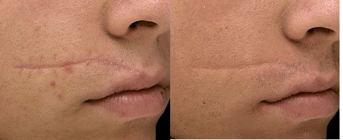 Scar revision before and after